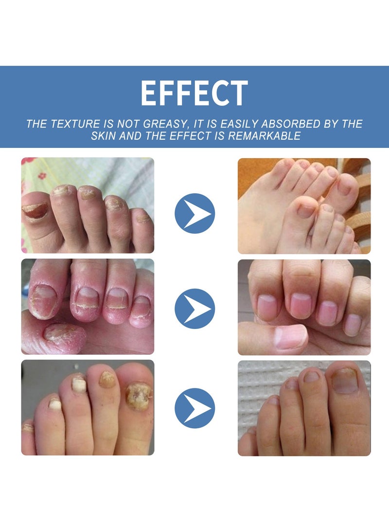 OUHOE Nail Care Gel Hand and Foot Onychomycosis Nail Shine Nail Repair Gel Soft Nail Thickening Type