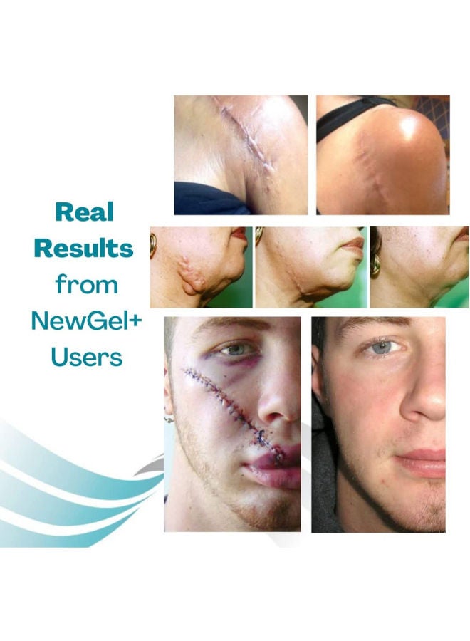 Silicone Gel Dots Beige For Scar Removal