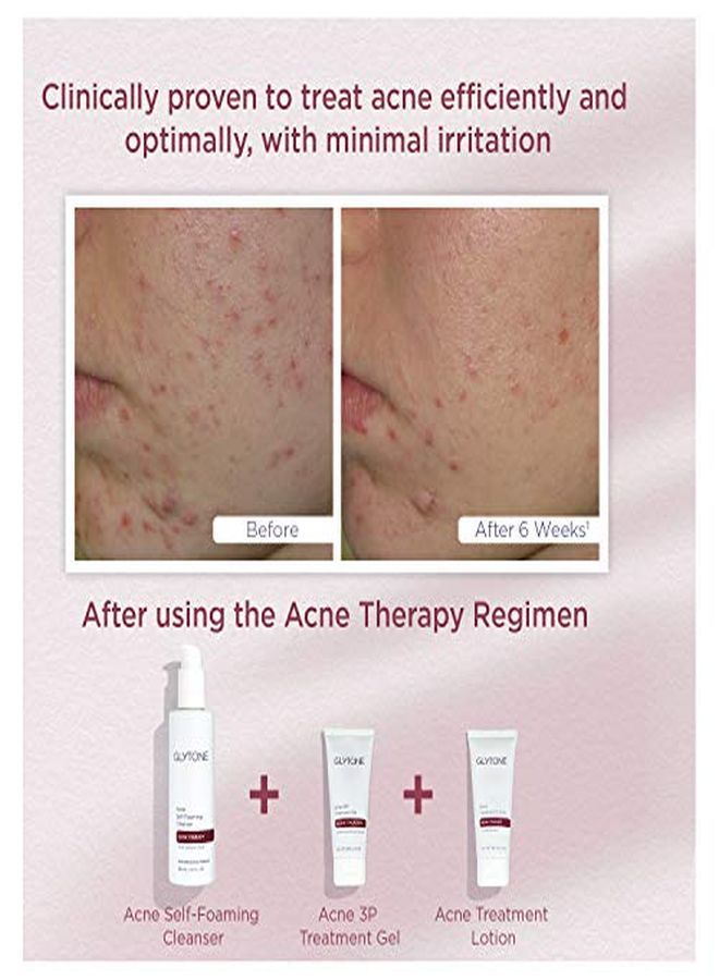 Acne Bpo Treatment Gel, Benzoyl Peroxide Acne Gel, 2 Fl.Oz.