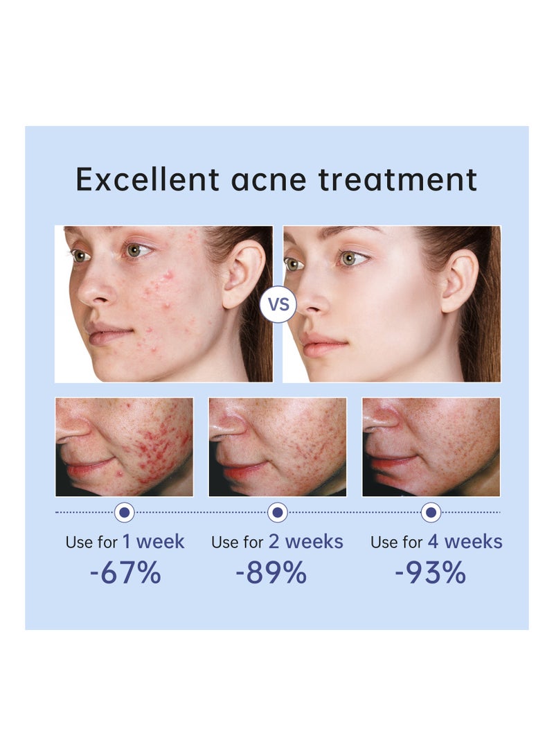 Herbal Acne Treatment Cream Pimple Spot Removal for Teens Oil Control Acne Scar Gel Shrink Pores Skin Care Beauty Health