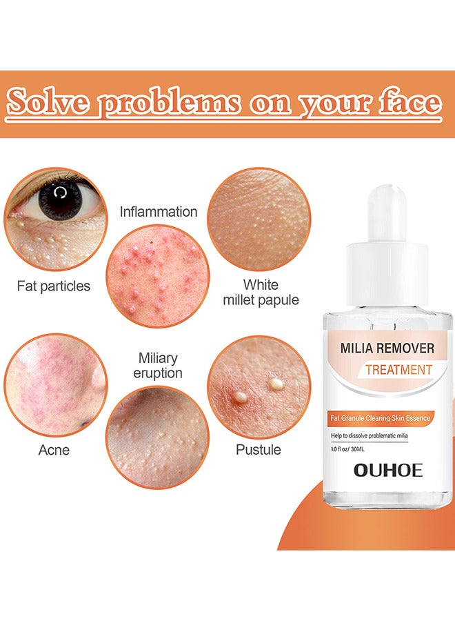 Milia Removal Treatment, Milia Spot Treatment Helps Dissolve And Reduce Milia, Whitehead And Sebaceous Hyperplasia, Cysts And Sebaceous Hyperplasia Face Serum 30 ML