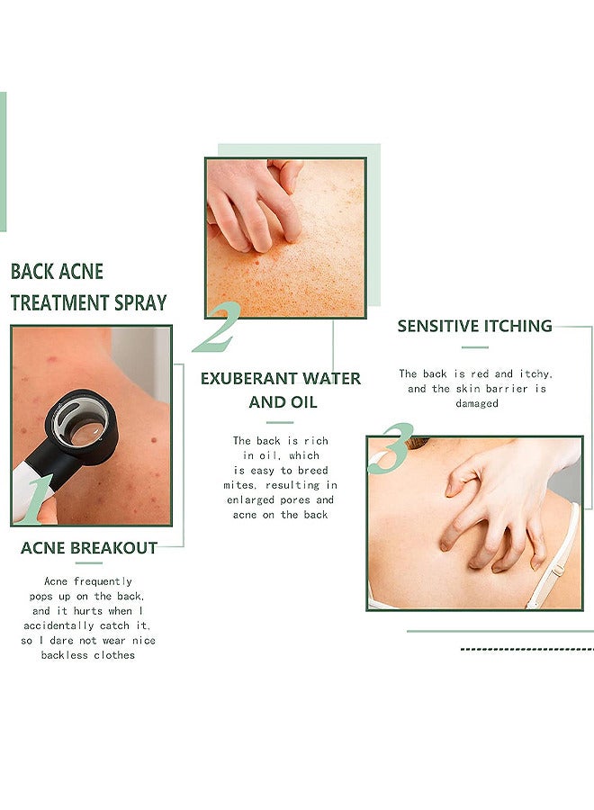 120ML Back Acne Treatment Soothing Spay, Back Acne Spray, Niacinamide Spray, Body Acne Treatment with Herbal Formula, Tea Tree Oil Spray, Body Acne Treatment Spray For Teens, Gentle On Skin