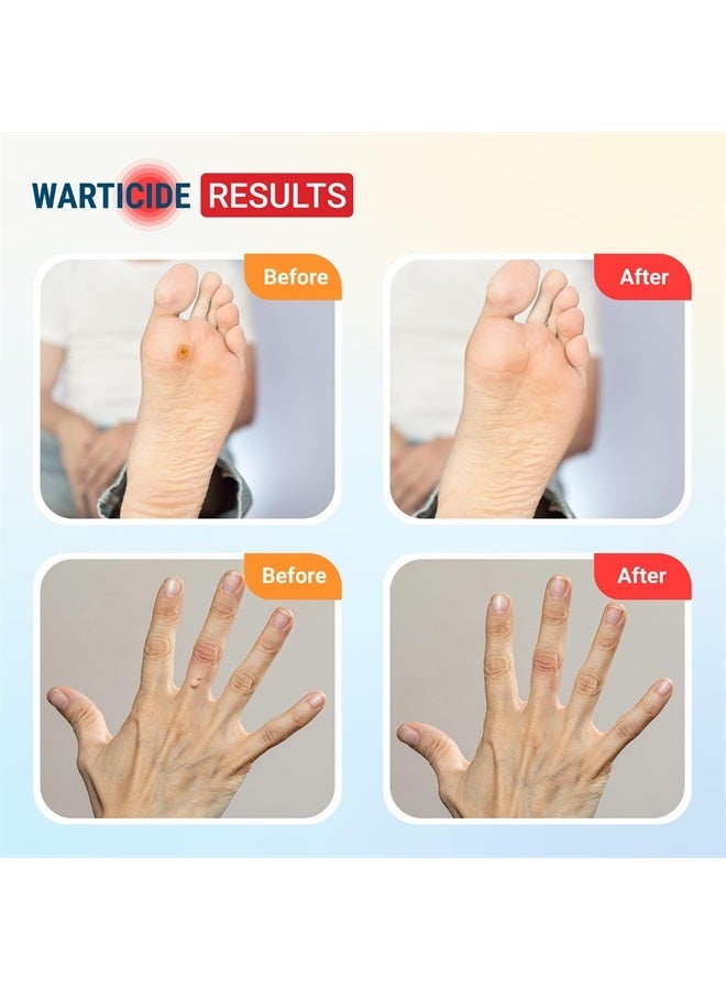 Fast-Acting Wart Remover - Effective Plantar and Genital Wart Removal with Natural Ingredients - Attacks Warts On Contact, Easy Dropper Application (2 Bottles, 1 fl oz Each)