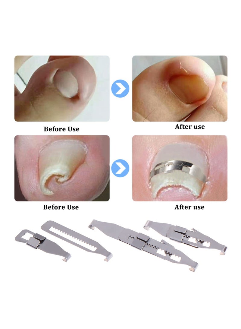 Ingrown Straightening Clips Toenail Pedicure Tool Curved Brace Toenails Thick Paronychia Correction Tool, Ingrowing Nail Treatment Kit, 2 Sizes 4 Pcs