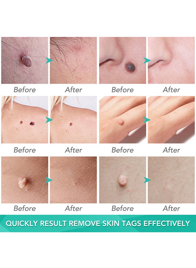 2 In 1 Skin Tag Removal Tool Kit Painless Easy-Using Device For Small To Large Sized Skin Tag On Face Neck And Body， Double Head Wart Removal Tool Skin Tag Removal Green