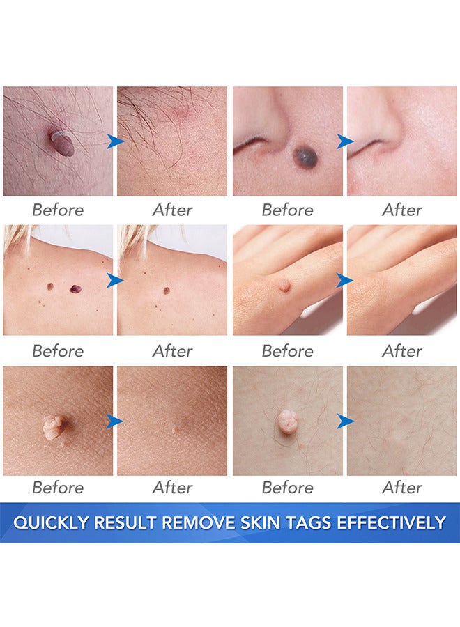 2 In 1 Skin Tag Removal Tool Kit Painless Easy-Using Device For Small To Large Sized Skin Tag On Face Neck And Body， Double Head Wart Removal Tool Skin Tag Removal Blue
