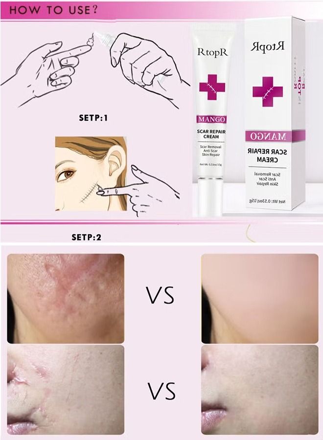 Scar Removal Cream Skin Repair Creams Treatment Stretch Marks Acne Surgical Care 15g