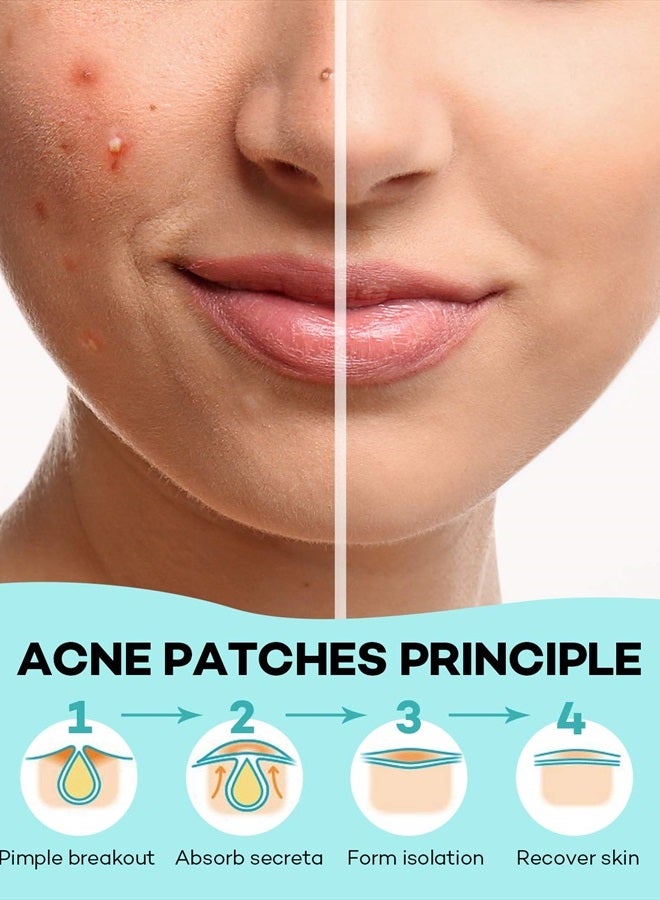 Acne Patch Pimple Patch, 4 Sizes 140 Patches Acne Absorbing Cover Patch, Hydrocolloid Invisible Acne Patches For Face Zit Patch Acne Dots Tea Tree, Calendula Oil