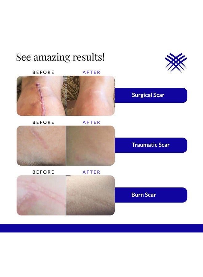 Rejuvasil Silicone Scar Gel Scar Treatment For Surgical Scars For Face, Body, Burn, Keloids, And Acne Scar Silicone Gel For Scars To Reduced The Appearance Of Old & New Scar 30Ml