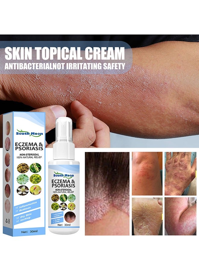 Eczema & Psoriasis Non-Steroidal100% Natural Relief，Dermatitis And Eczema Pruritus Psoriasis Spray, Say Goodbye To Scaly Skin, Eczema Relief Spray, Stops Burning And Itching 30ML