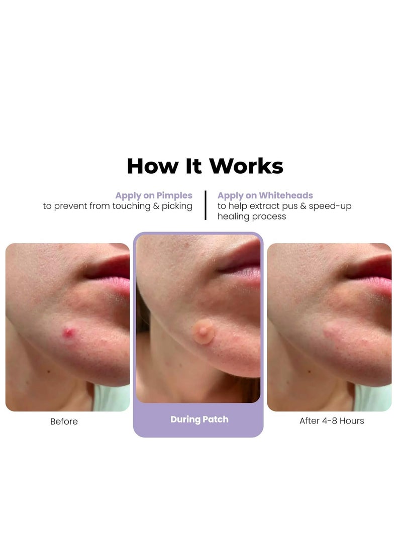 ROSELYNBOUTIQUE Pimples Patches for Face - 300 Counts 4 Sizes Hydrocolloid Acne Patches Fast Absorb