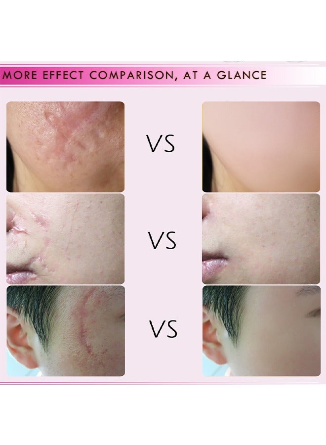 Scar Repair Cream-Skin Repair Creams Treatment Stretch Marks Acne Surgical Care 15g