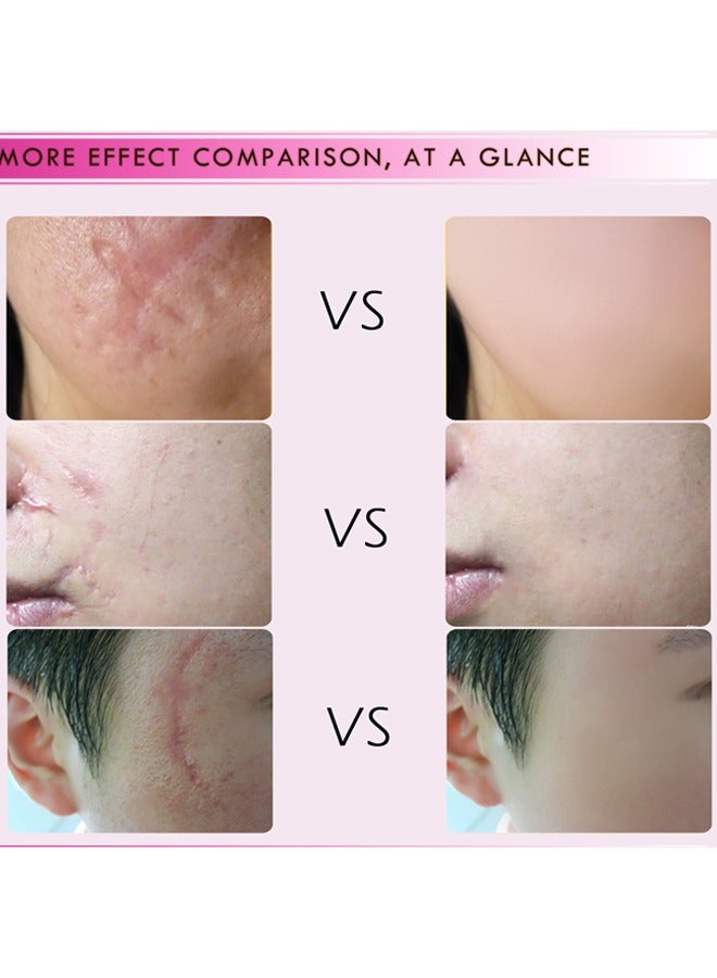 Mango Scar Removal Cream-Scar Skin Repair Treatment Stretch Marks Acne Surgical Care 15g