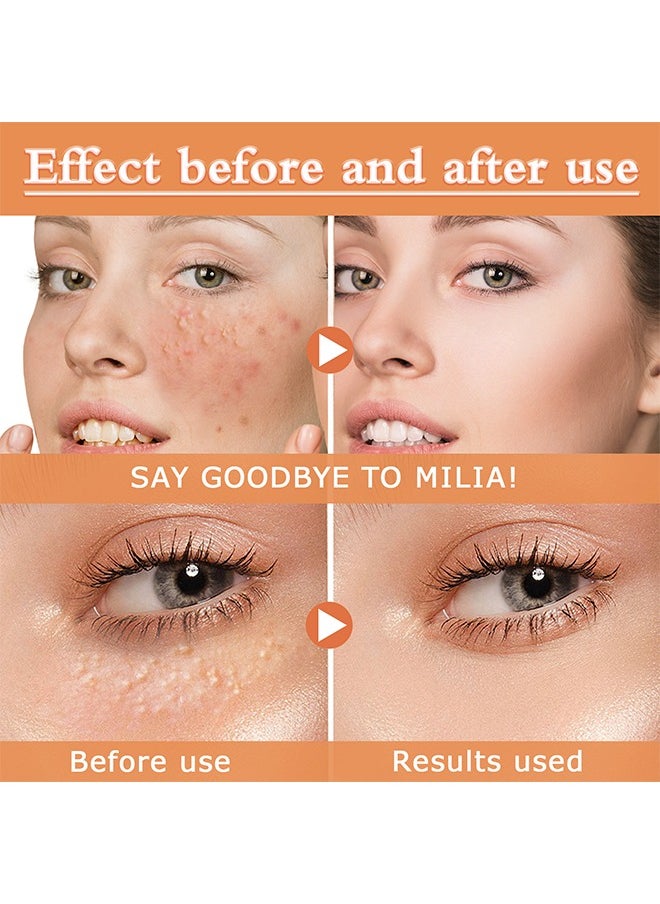 Fat Particles Treatment-Fat Granule Clearing Skin Essense，Fat Granules Removal Eye Serum, Natural Formula Milia Remover Milia Spot Treatment, Anti Dark Circle Fade Fine Essence, Anti Puffiness Moisturizing Skin Care Serum