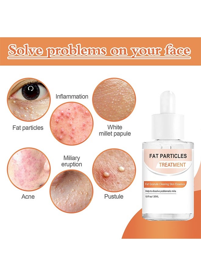 Fat Particles Treatment-Fat Granule Clearing Skin Essense，Fat Granules Removal Eye Serum, Natural Formula Milia Remover Milia Spot Treatment, Anti Dark Circle Fade Fine Essence, Anti Puffiness Moisturizing Skin Care Serum