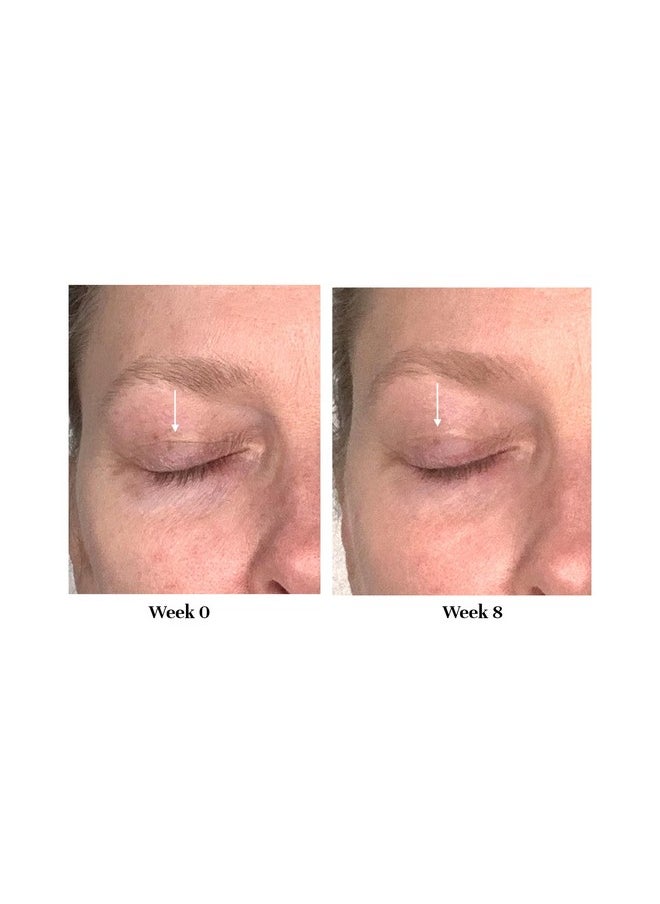 Lid Lifting Treatment| Hooded Eyelid Lift Treatment Cream | Eye Tightening Treatment For Sagging Eyelids