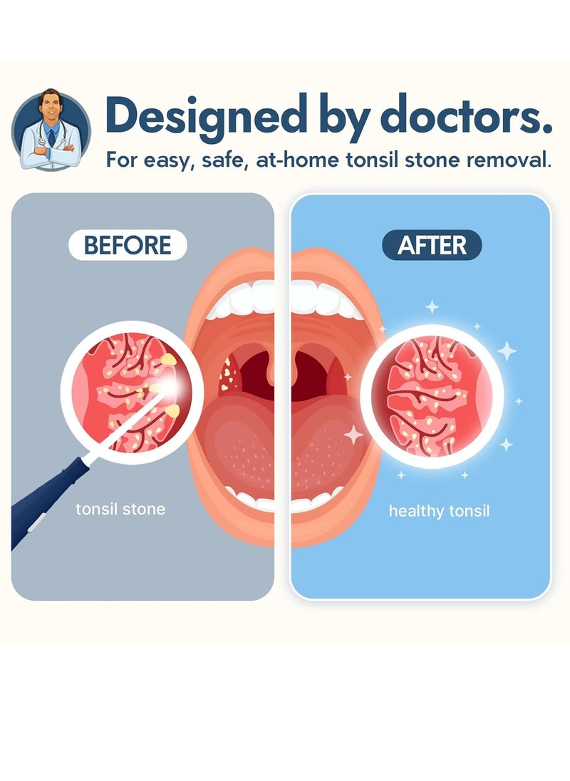 Dr. Frederick’s Original Easy Tonsil Stone Remover Kit - Fast Painless Tonsillolith Removal Tool - Fight Bad Breath - Pick and Oral Irrigator - 8 Pieces
