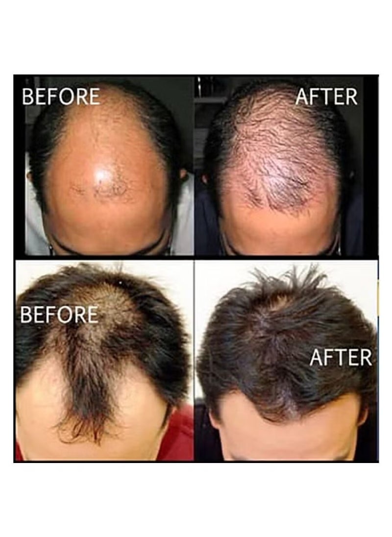 Kirkland Minoxidil 5% Extra Strength Liquid – 3-Month Supply for Men, 180ml Total
