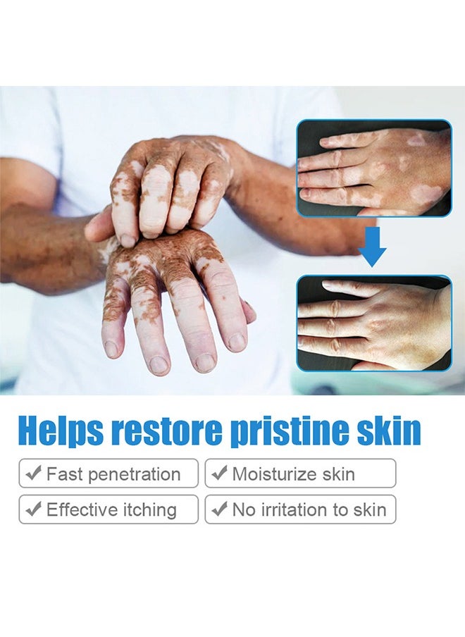 Vitiligo Ointment, Vitiligo Care Cream for Skin Vitiligo, Psoriasis, Leukoplakia, Reduces White Spots, Improve Skin Pigmentation Regulating 20g