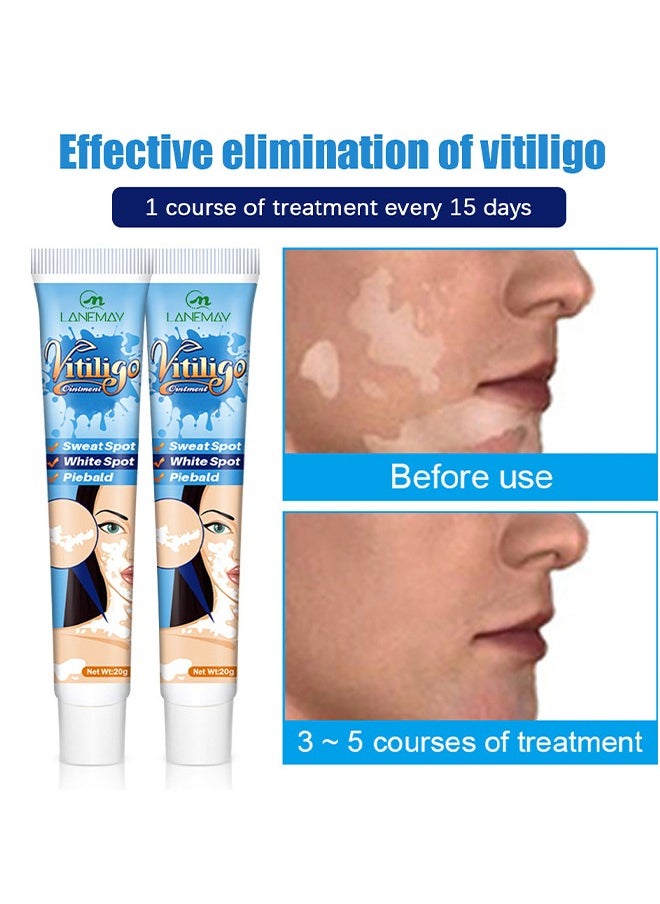 Vitiligo Ointment, Vitiligo Care Cream for Skin Vitiligo, Psoriasis, Leukoplakia, Reduces White Spots, Improve Skin Pigmentation Regulating 20g