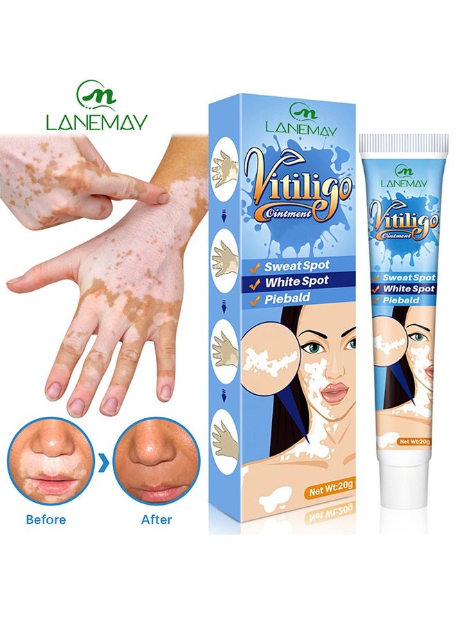 Vitiligo Ointment, Vitiligo Care Cream for Skin Vitiligo, Psoriasis, Leukoplakia, Reduces White Spots, Improve Skin Pigmentation Regulating 20g