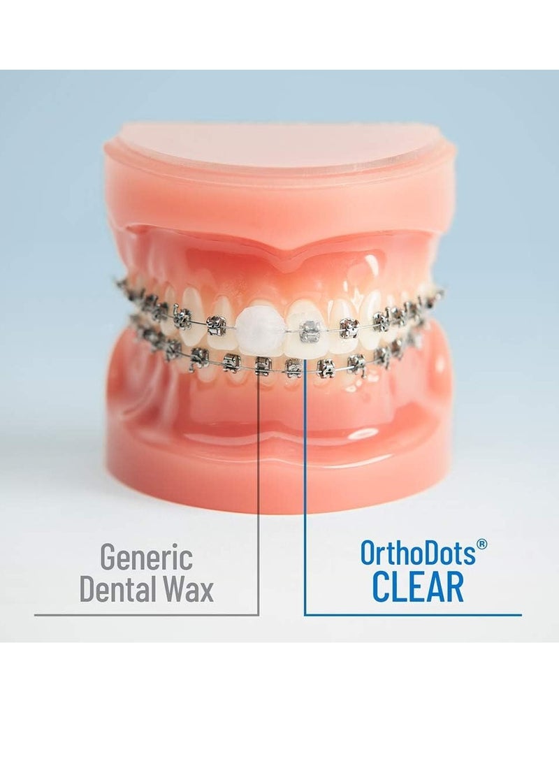 OrthoDots CLEAR – Moisture Activated Braces Wax Alternative for Pain Caused by Braces, Clear Aligner Trays, and Other Orthodontic Appliances. OrthoDots Stick Better and Stay on Longer than Dental Wax.