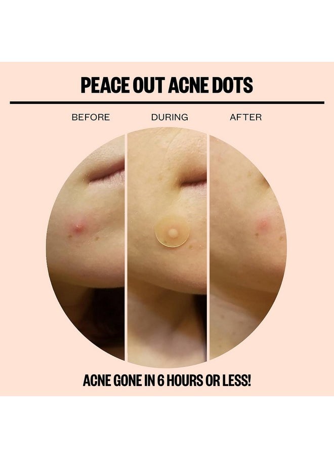 Skincare Acne Dots, Hydrocolloid Pimple Patches Help Clear Blemishes Overnight, Award Winning Fast Acting Anti-Acne Solution (20 Dots)