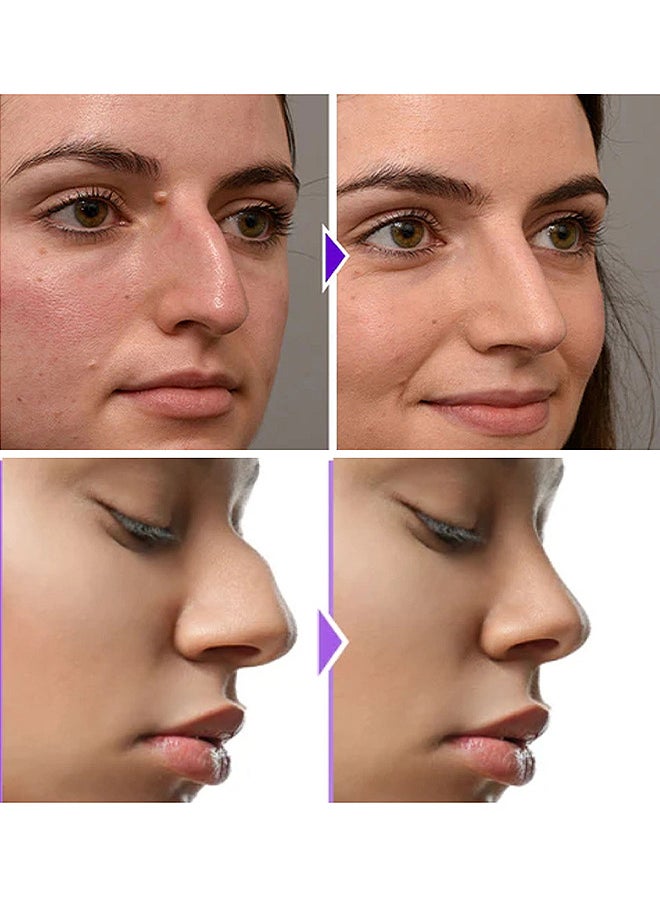 Noselift Nose Sculpfing Device, With 10 Minutes Of Daily Use, Takes On Loose Cartilage And Skin On The Nose's Tip, Giving You A Firmer And More Youthful Appearance, Comfortable And User-Friendly