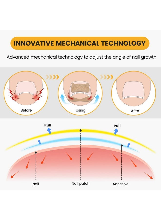 60Pcs Breathable Ingrown Toenail Corrector Patches And 50Pcs Ingrown Toenail Stickers - Professional Ingrown Toe Nail Treatment Tape For Pain Relief And Correction
