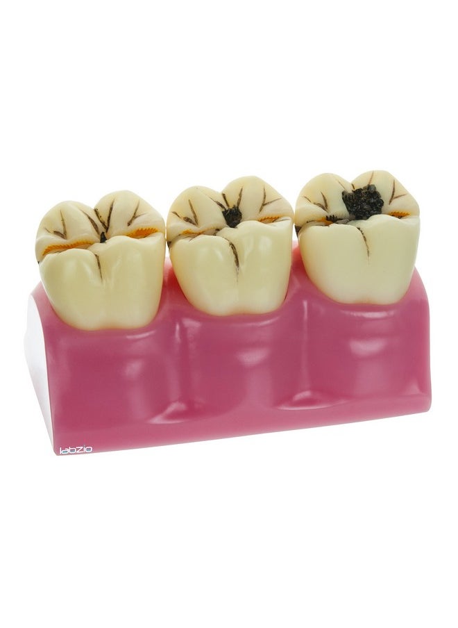 By Eisco - Staged Model Of Decaying Tooth, Removable And Dissectible Teeth, 7 Parts, Enlarged For Better Observation