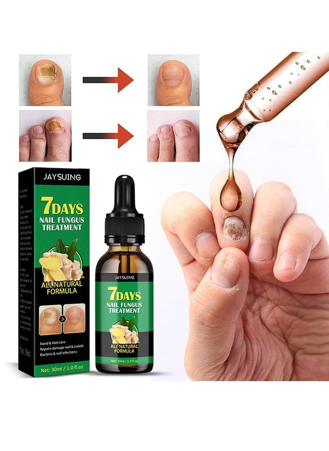 7 DAYS Nail Fungus Treatment,Ginger Nail Treatment Nail Support Nail Care, , Ginger Nail Growth Serum, Ginger Cuticle Care Oil for Nails 30ml