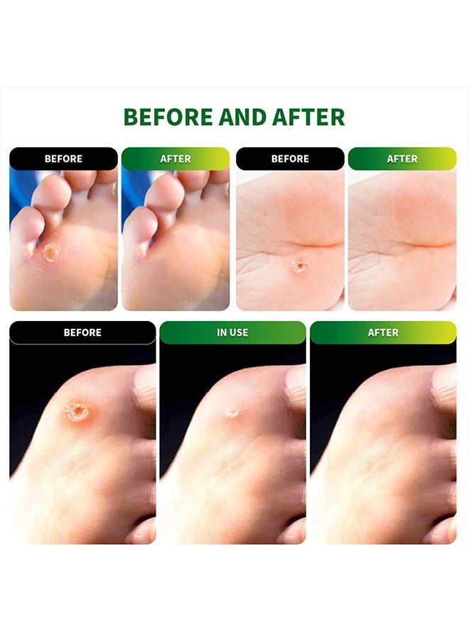 54 Pcs Foot Corn Removal Plaster,Natural Ingredients,Foot Care Expert,Calluses Plantar Treatment,Relief Pain From Calluses, Corns, Blisters, Heel Frictions