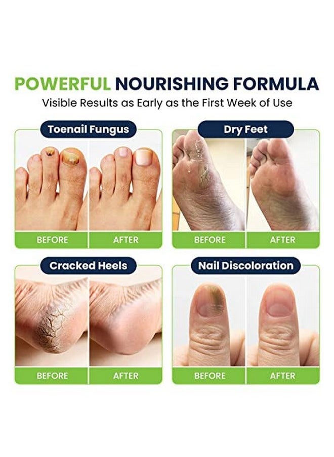 Toenail Fungus Treatment Extra Strength - Advance nail fungus treatment for fingernails, nail repair, toenail softener, yellow toenail treatment, ingrown nail and foot fungus treatment extra strength