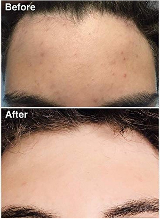Teenology Shampoo for Teens - Avoid Forehead and Body Acne - No Sulfates or Parabens, Noncomedogenic, Natural Botanical Extracts, 16 oz. (Sweet Mint)