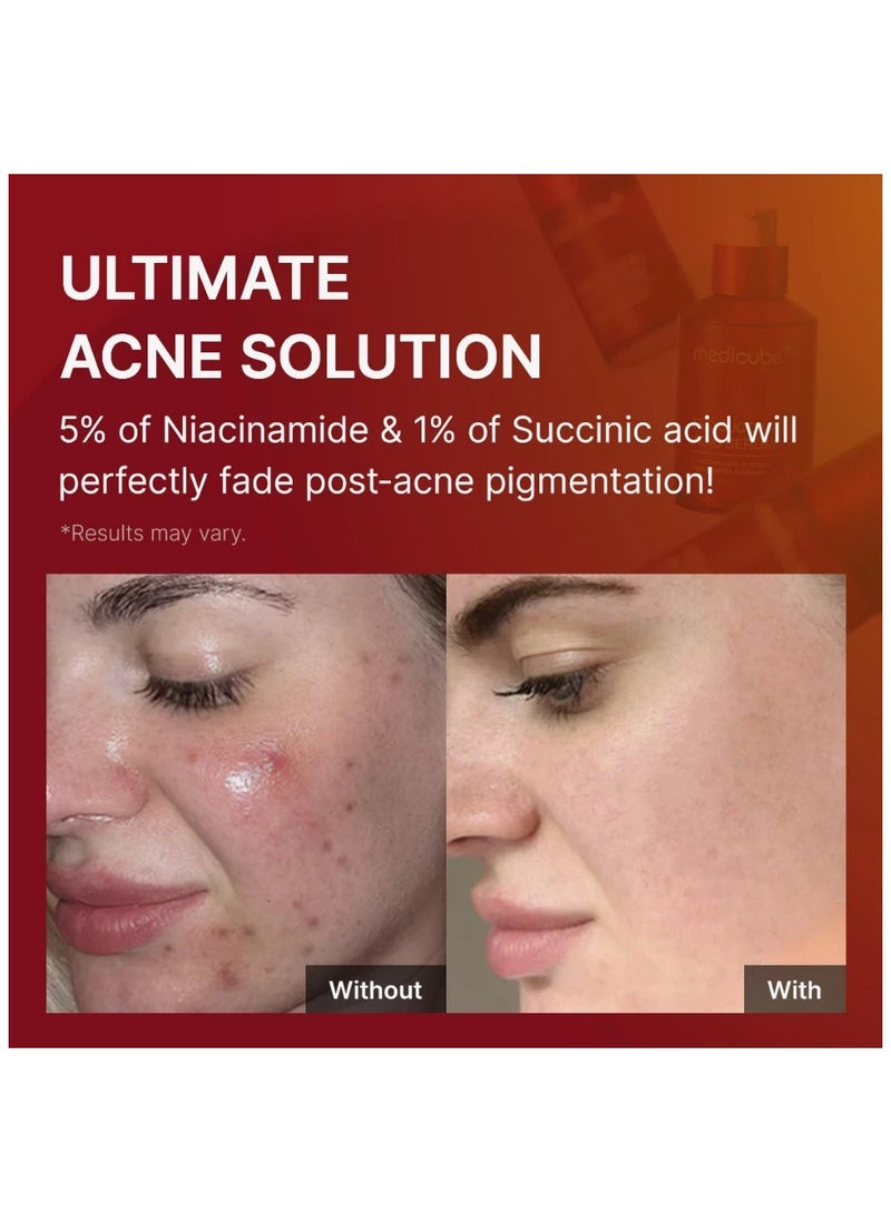 Red Succinic Acid Acne Serum for Acne Treatment & Pigmentation Brightening - Powerful Blend of Salicylic Acid & Niacinamide - 30ml