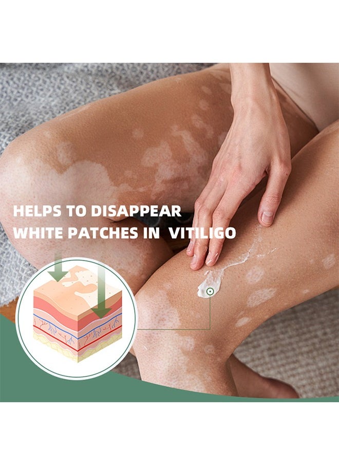 Vitiligo Relief Cream, Treatment for Skin Vitiligo Ointment, Fade White Spot and Improve Skin Pigmentation Cream, Vitiligo Cream for Skin Healthy Care 20G