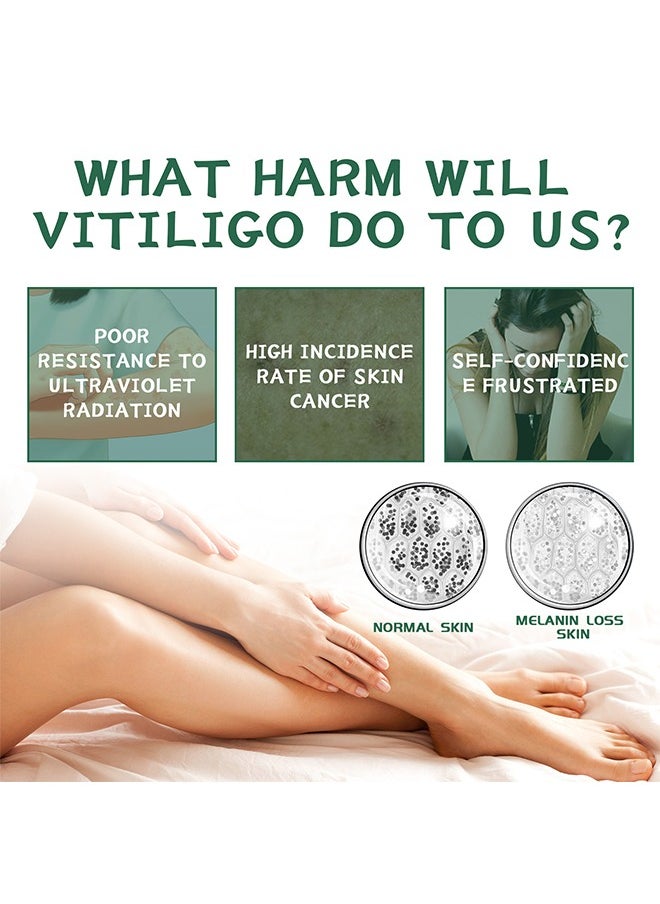 Vitiligo Relief Cream, Treatment for Skin Vitiligo Ointment, Fade White Spot and Improve Skin Pigmentation Cream, Vitiligo Cream for Skin Healthy Care 20G