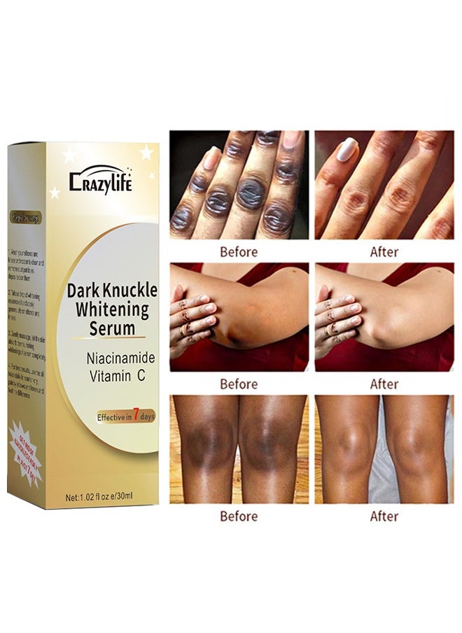 Dark Knuckle Whitening Serum, Joint Darkening Serum, Lighten And Repair Melanin, Skin Care Removal Body Bleaching For Knuckle Elbows 30ml