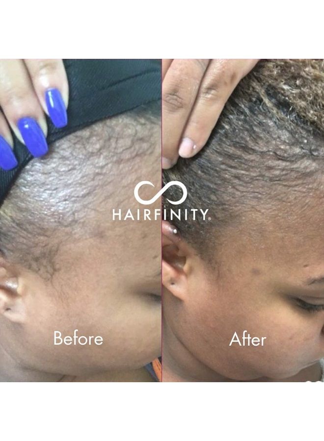 Infinite Edges Hair Serum - Hair Growth Treatment to Prevent Hair Loss and Stimulate Hair Follicles to Stop Hair Loss and Regrow Hair - Targets Causes of Alopecia - Sulfate & Silicone Free