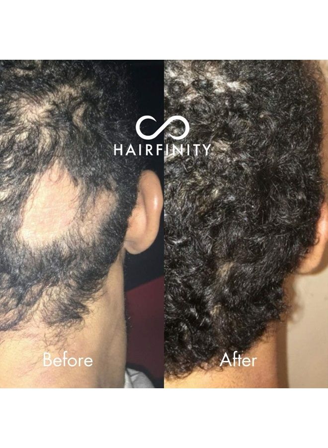 Infinite Edges Hair Serum - Hair Growth Treatment to Prevent Hair Loss and Stimulate Hair Follicles to Stop Hair Loss and Regrow Hair - Targets Causes of Alopecia - Sulfate & Silicone Free