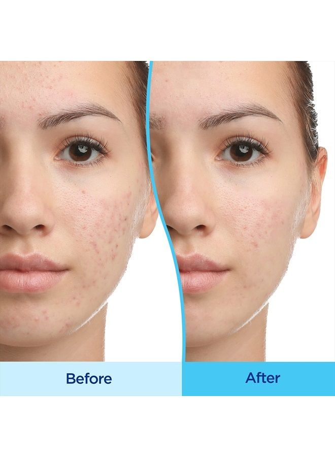 Acne Treatment Gel, 90 Day Supply, Retinoid Treatment for Face with 0.1% Adapalene, Gentle Skin Care for Acne Prone Sensitive Skin, 45g Pump (Packaging May Vary)