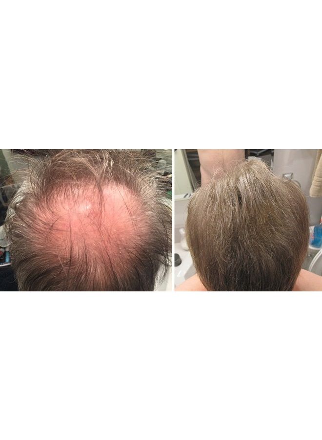 Hair Loss Concealer. Makes Thin Hair Look 10X Fuller Instantly. Eliminates Bald Spot and Thinning Hair (30G, 90-Day Supply). Light Brown