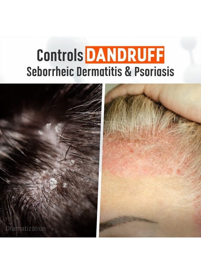 Coal Tar Gel Dandruff Shampoo to Treat Seborrheic Dermatitis Psoriasis, 6 Ounce (Pack of 1)