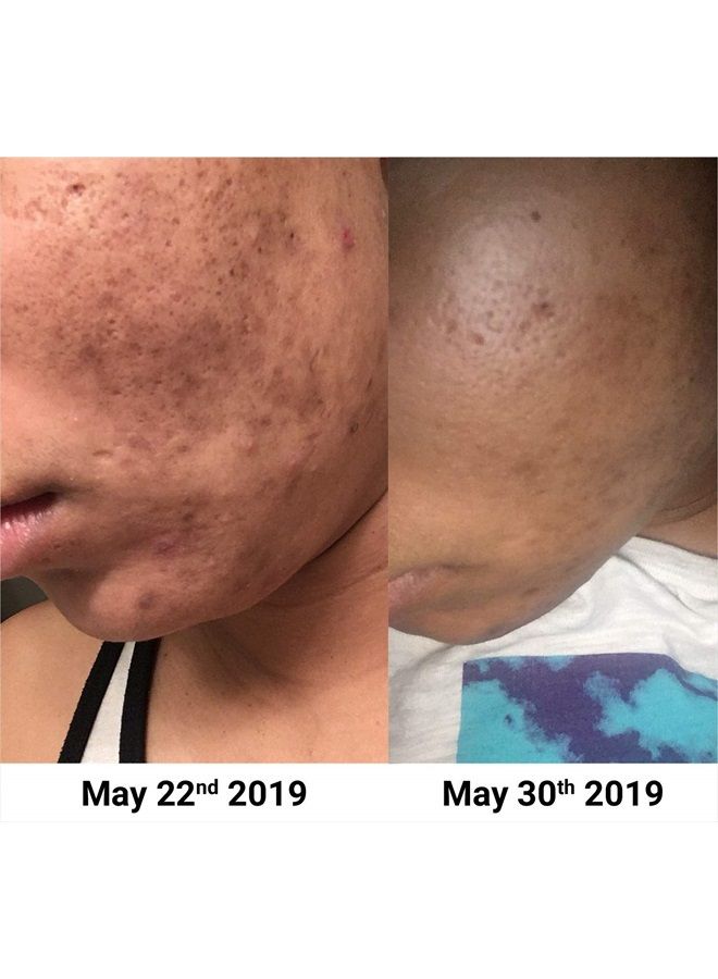 NxN Vitamin C & Hyaluronic Acid Serum Set, Clinically Proven to Brighten Skin, Reduce Dark Spots, Improve Hyper Pigmentation Age Spots, Reduce Fine Lines & Wrinkles - 1fl oz Face Kit