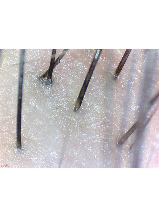 DE300 Digital Dermatoscope for Telehealth, Telemedicine, Dermatology, Trichology, and Skin Care. F.D.A. and C.E. Certified.