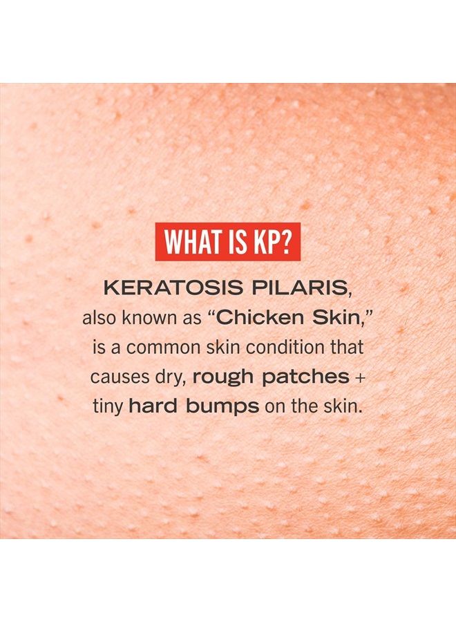 KP Bump Eraser Body Scrub Exfoliant for Keratosis Pilaris with 10% AHA 2 oz.