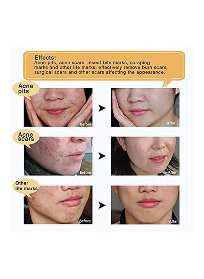 2-Piece Tcm Scar And Acne Mark Removal Gel Ointment Set 30grams