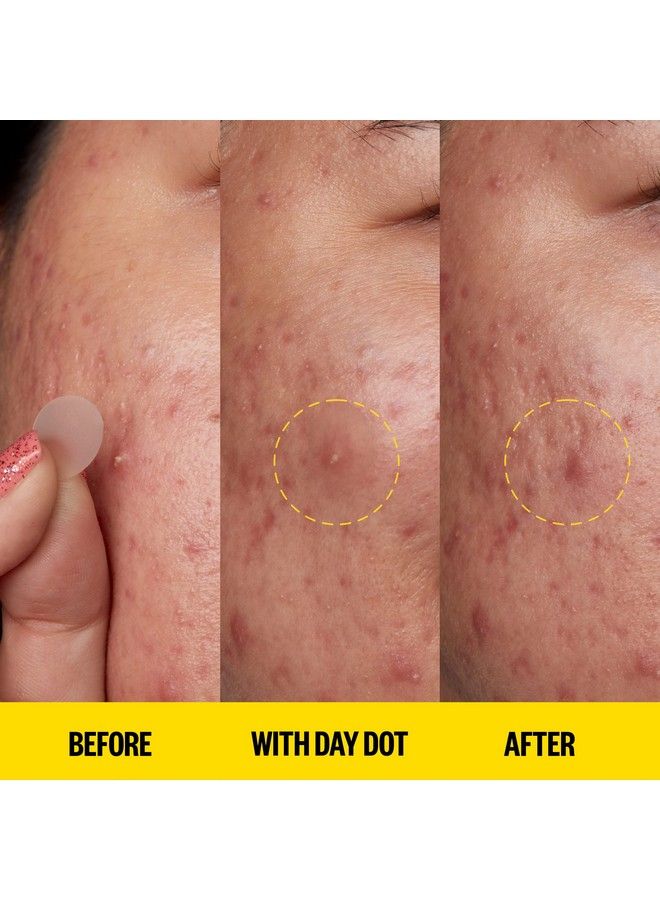 Skincare Acne Day Dot Jumbo | 6Hour Fast Acting Sheer Hydrocolloid Pimple Patches With Salicylic Acid | Ultrathin Virtually Invisible | Quickly Clear Breakouts Blemishes And Zits (40 Dots)