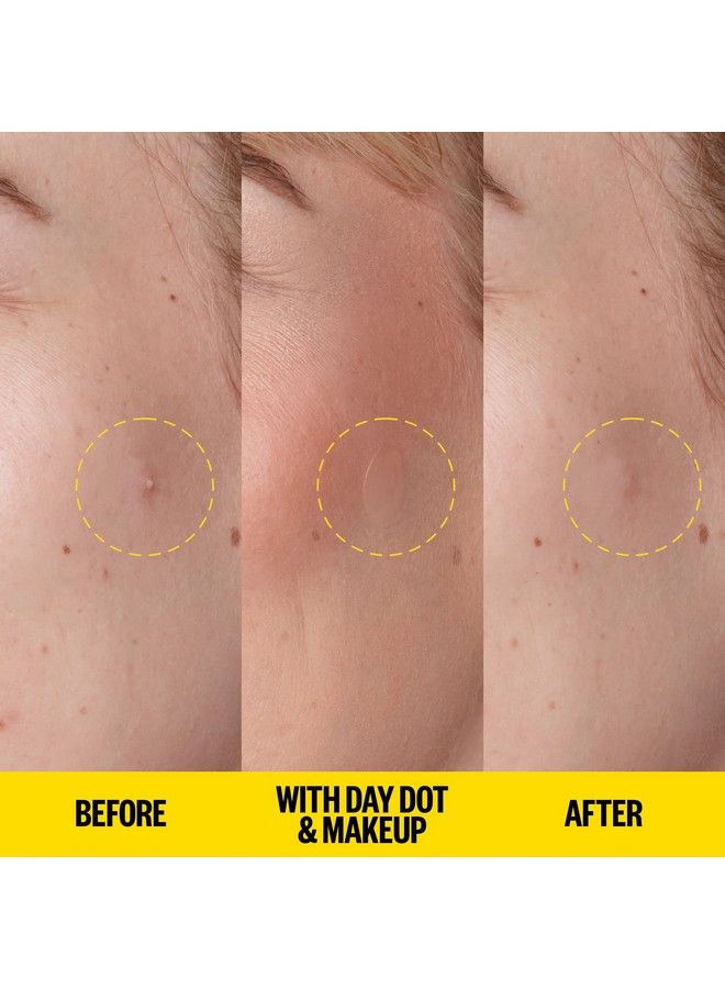 Skincare Acne Day Dot Jumbo | 6Hour Fast Acting Sheer Hydrocolloid Pimple Patches With Salicylic Acid | Ultrathin Virtually Invisible | Quickly Clear Breakouts Blemishes And Zits (40 Dots)