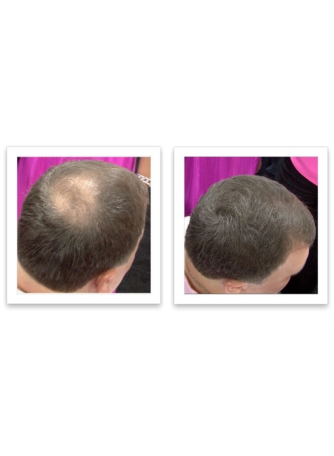 All-Natural Hair Building Fiber. Make Thin Hair Look 10X Fuller Instantly. Eliminate the Appearance of Bald Spot and Thinning Hair (30G, 90-Day Supply). Medium Brown